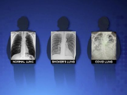 Как выглядят легкие пациента с COVID-19 и курильщика: шокирующие снимки