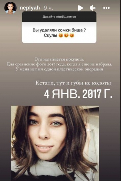 ''Мисс Украина Вселенная'' Анна Неплях показала, как выглядела до увеличения губ