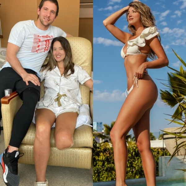 Участнице "Мисс Вселенная" ампутировали ногу: фото до и после операции 